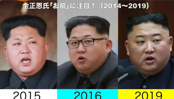 金正恩爆健康疑云!脸上长满「诡异肉芽」无修图照曝光